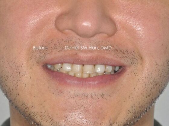Cosmetic Dentistry: Case 12 - Before