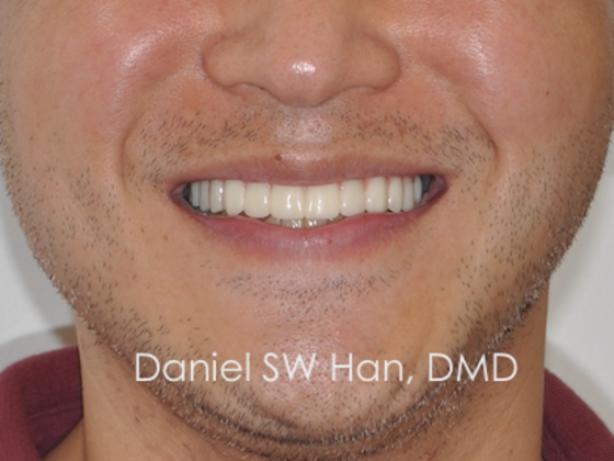 Cosmetic Dentistry: Case 12 - After
