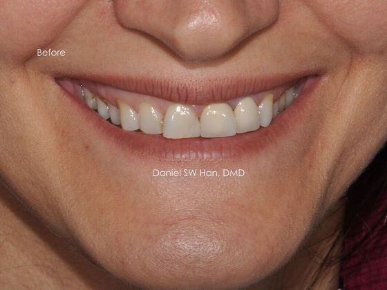 Cosmetic Dentistry: Case 13 - Before