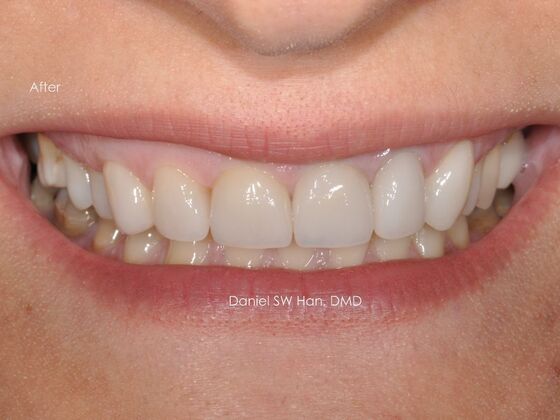 Cosmetic Dentistry: Case 13 - After