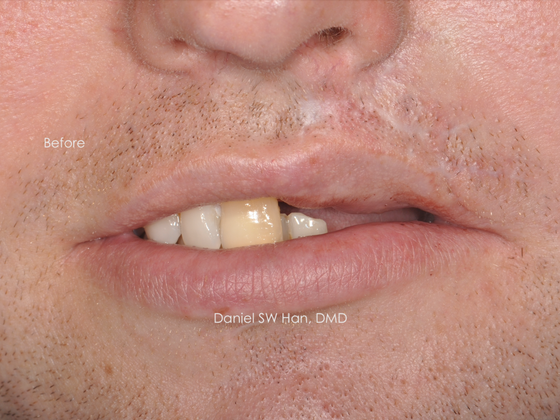 Cosmetic Dentistry: Case 15 - Before