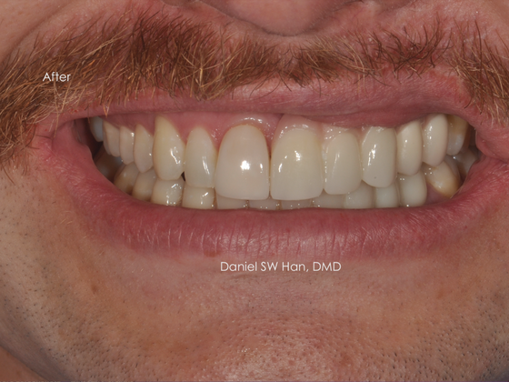 Cosmetic Dentistry: Case 15 - After