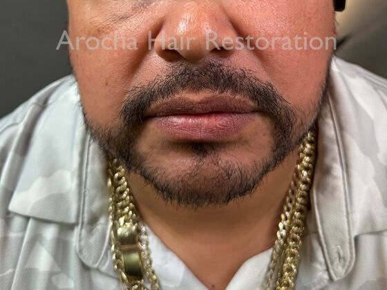 Facial Hair Transplantation: Case 13 - After