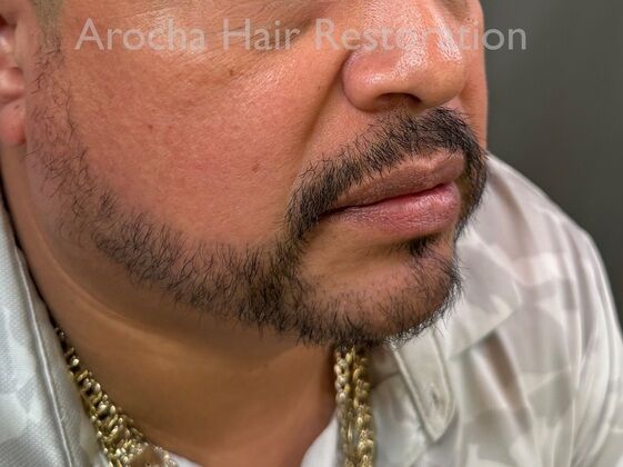 Facial Hair Transplantation: Case 13 - After