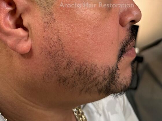 Facial Hair Transplantation: Case 13 - After