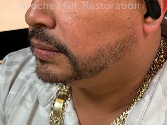 Facial Hair Transplantation: Case 13 - After
