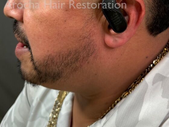 Facial Hair Transplantation: Case 13 - After