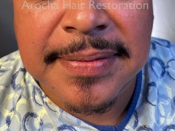 Facial Hair Transplantation: Case 13 - Before