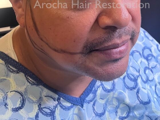 Facial Hair Transplantation: Case 13 - Before