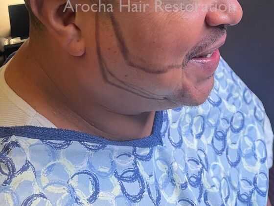 Facial Hair Transplantation: Case 13 - Before