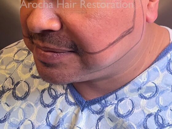 Facial Hair Transplantation: Case 13 - Before