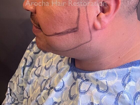Facial Hair Transplantation: Case 13 - Before