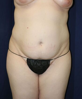 LIPOSUCTION 360*: Case 6 - Before