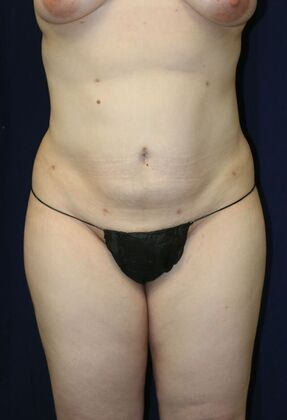 LIPOSUCTION 360*: Case 6 - After