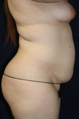 LIPOSUCTION 360*: Case 6 - Before