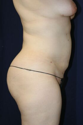 LIPOSUCTION 360*: Case 6 - After
