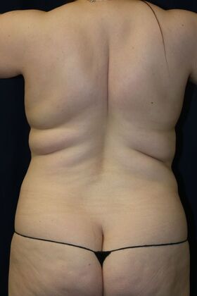 LIPOSUCTION 360*: Case 6 - Before