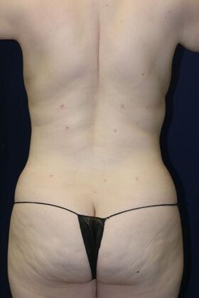 LIPOSUCTION 360*: Case 6 - After