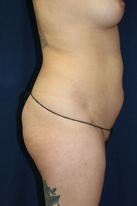 Brazilian Butt Lift : Case 19 - Before