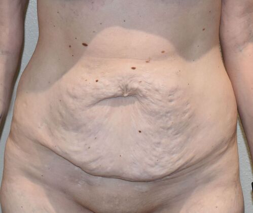 Tummy Tuck (Abdominoplasty): Case 456 - Before