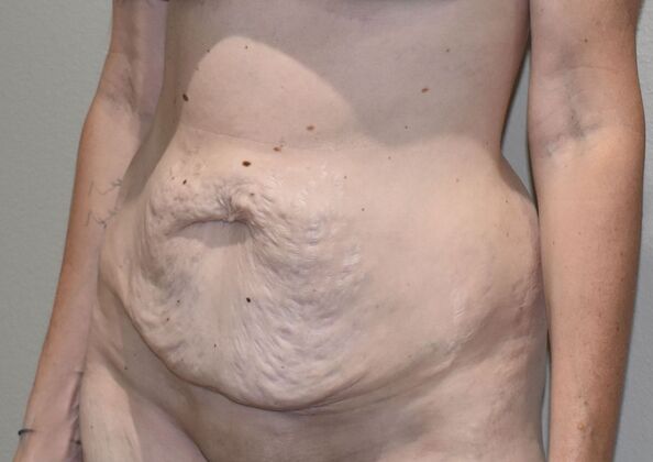 Tummy Tuck (Abdominoplasty): Case 456 - Before