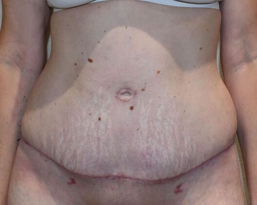 Tummy Tuck (Abdominoplasty): Case 456 - After
