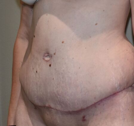 Tummy Tuck (Abdominoplasty): Case 456 - After