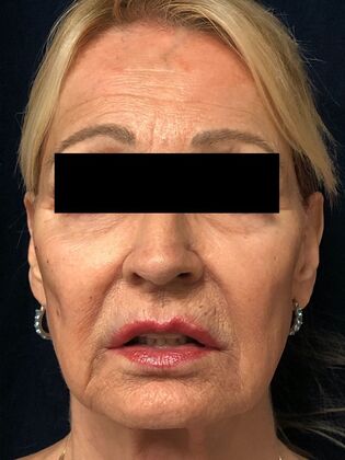 Cosmetic Injectables & Fillers*: Full Facial Balancing Case 1 - Before