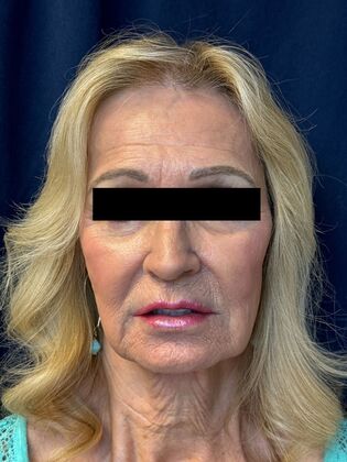 Cosmetic Injectables & Fillers*: Full Facial Balancing Case 1 - After