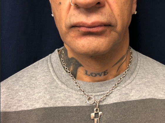 Cosmetic Injectables & Fillers*: Case 56 Lower Lip - Before