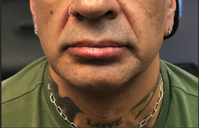 Cosmetic Injectables & Fillers*: Case 56 Lower Lip - After