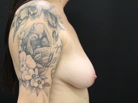 Breast Lift & Breast Lift Augmentation: Case 14 - Before