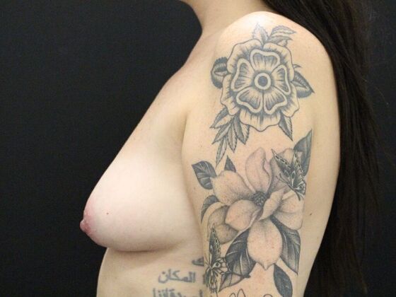 Breast Lift & Breast Lift Augmentation: Case 14 - Before