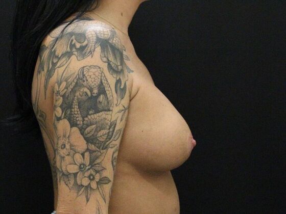 Breast Lift & Breast Lift Augmentation: Case 14 - After