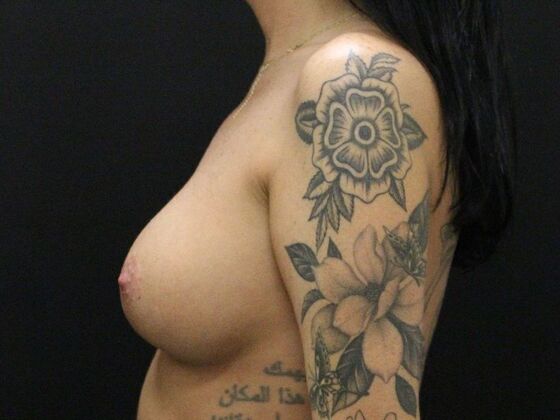 Breast Lift & Breast Lift Augmentation: Case 14 - After