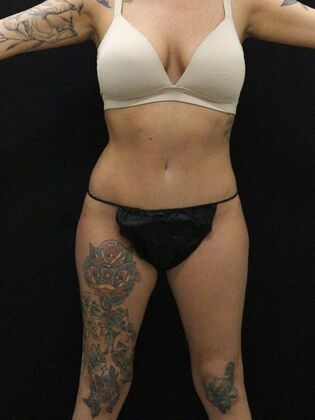 Tummy Tuck Case 30 - After