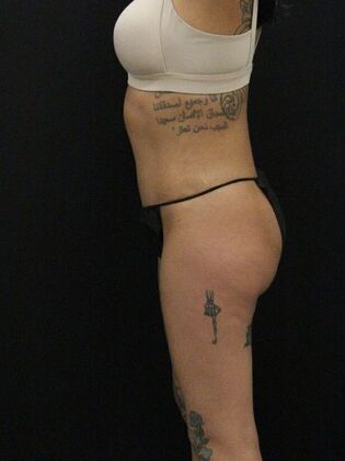 Tummy Tuck: Case 30 - After