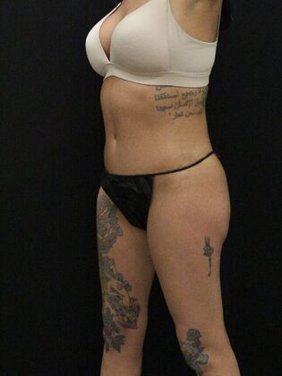 Tummy Tuck: Case 30 - After