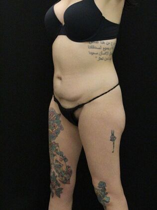 Tummy Tuck: Case 30 - Before