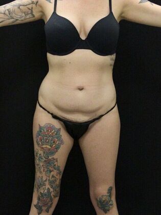 Tummy Tuck Case 30 - Before