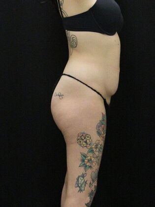 Tummy Tuck: Case 30 - Before