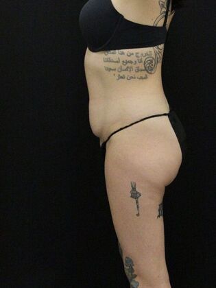 Tummy Tuck: Case 30 - Before