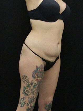 Tummy Tuck: Case 30 - Before