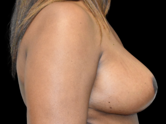 Breast Reduction: Case 6 - After