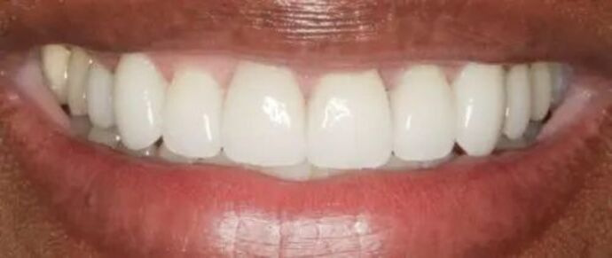 Smile Makeover & Veneers: Case 23 - After