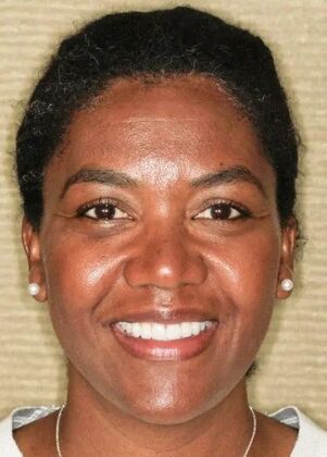 Smile Makeover & Veneers: Case 23 - After