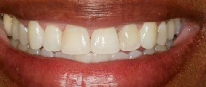 Smile Makeover & Veneers: Case 23 - Before