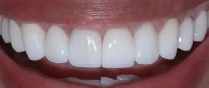 Smile Makeover & Veneers: Case 24 - After