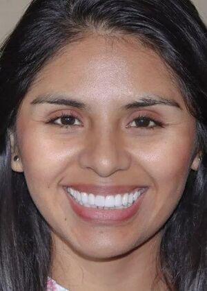 Smile Makeover & Veneers: Case 24 - After