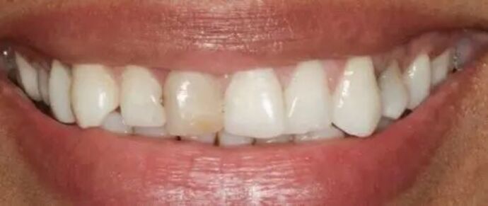 Smile Makeover & Veneers: Case 24 - Before